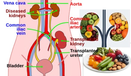 만성 신장 질환(CKD)에 대한 치료법은 없지만 치료를 통해 증상을 완화하고 악화되는 것을 막을 수 있습니다