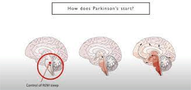 REM 수면 연구 결과는 호주인이 파킨슨 병을 더 빨리 진단하는 데 도움이 될 수 있습니다.