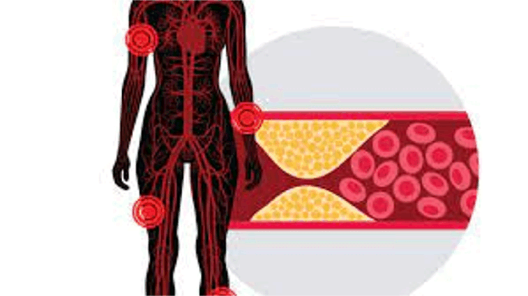 말초동맥질환은 여성에게 과소진단되는 ‘침묵의 살인자’