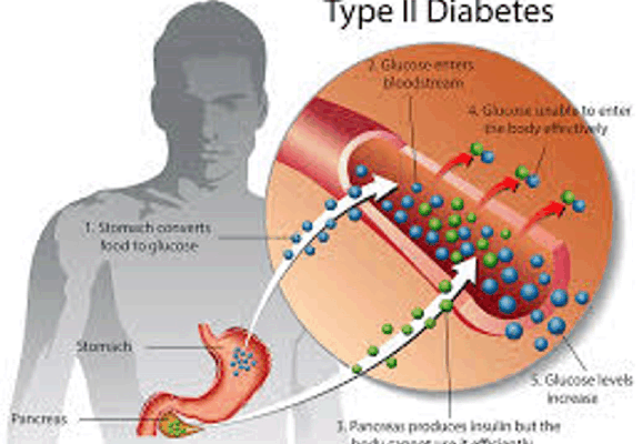 2형 당뇨병