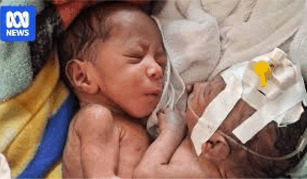 호주에서의 희망이 무산된 후 파푸아뉴기니의 결합 쌍둥이가 수술을 위해 독일로 보내질 수도 있습니다.