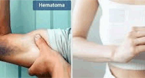 정맥이 터져서” “터짐” 또는 붓기가 발생하는 경우